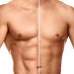 hipertrofia-santi-jacomet-orthos